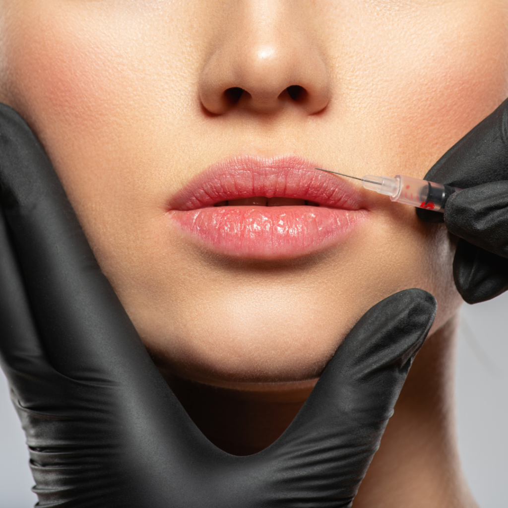 Close-up of a woman receiving a lip filler injection at Liv Med Spa, Sioux Falls